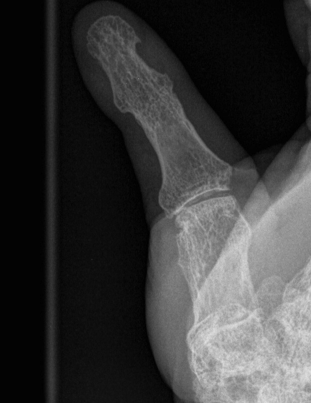 Rheumatoid Gamekeepers Thumb